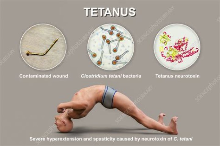 Can every cut cause tetanus?