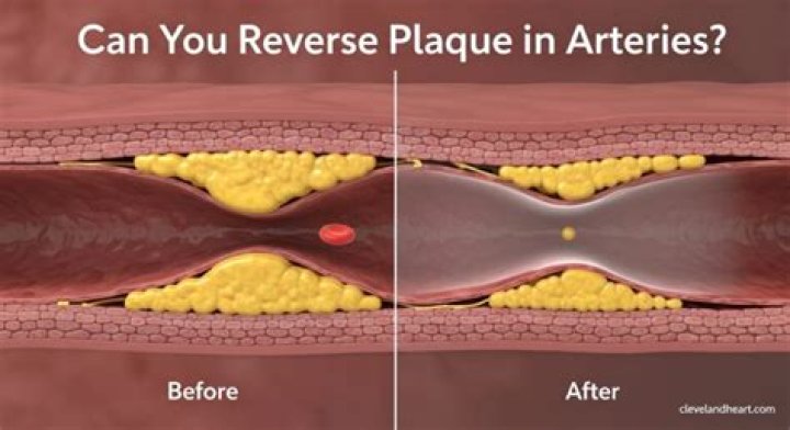 Can statins actually reverse plaque buildup?