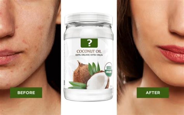Does coconut oil cause pimples?