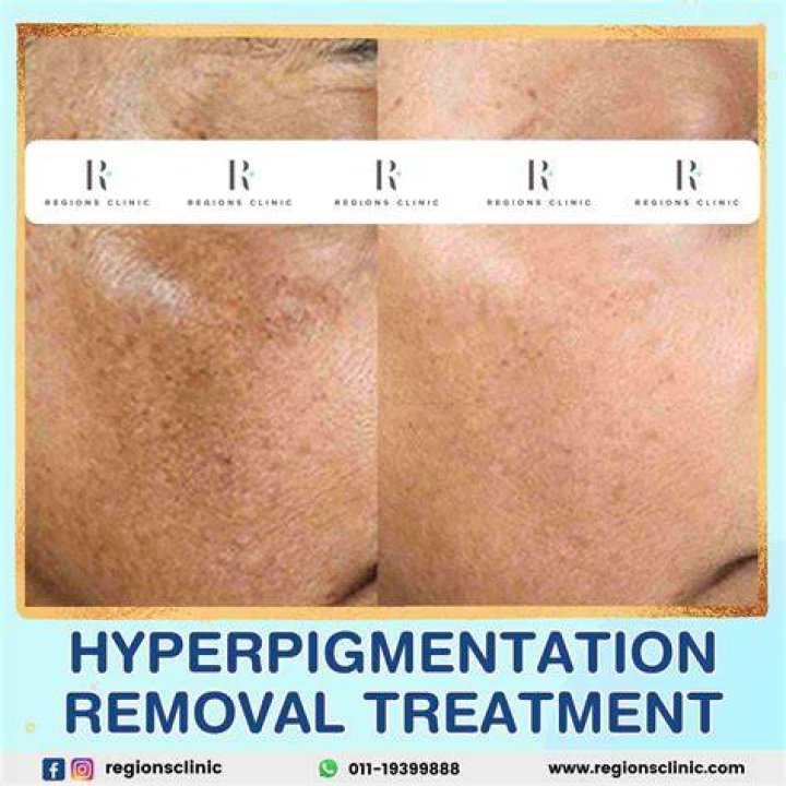 Does microdermabrasion get rid of pigmentation?