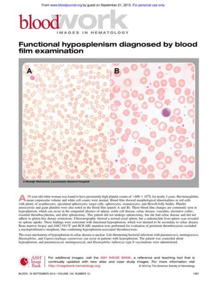 How is Hyposplenism diagnosed?