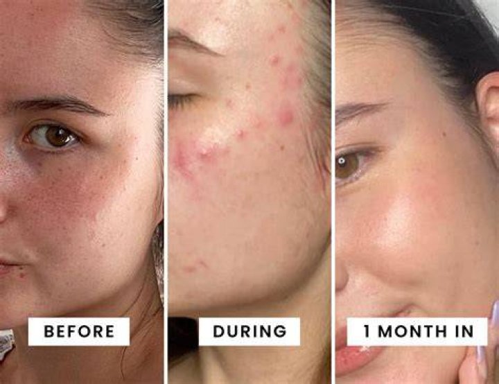 How long is retinol purge?
