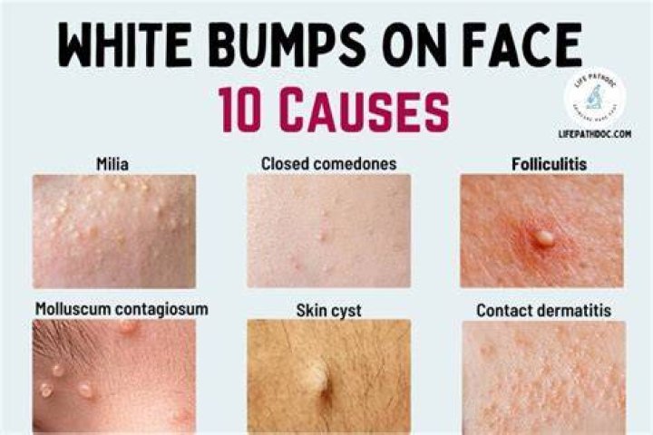 What are small bumps on face?