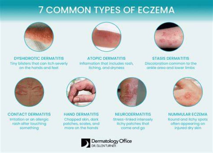 What should I wash my face with if I have eczema?