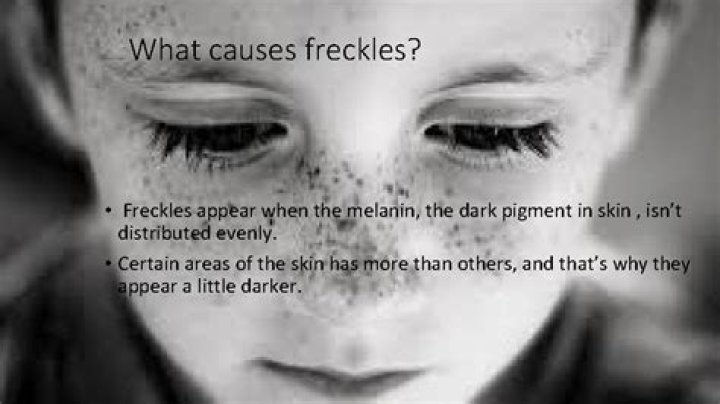 When do freckles appear in NF1?